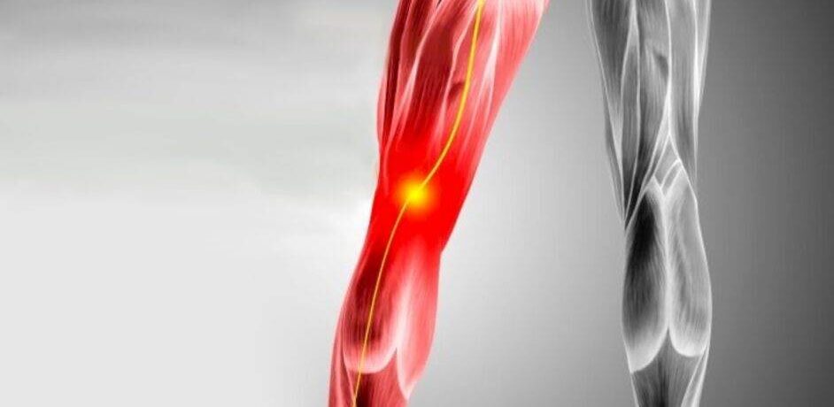 Sciatica